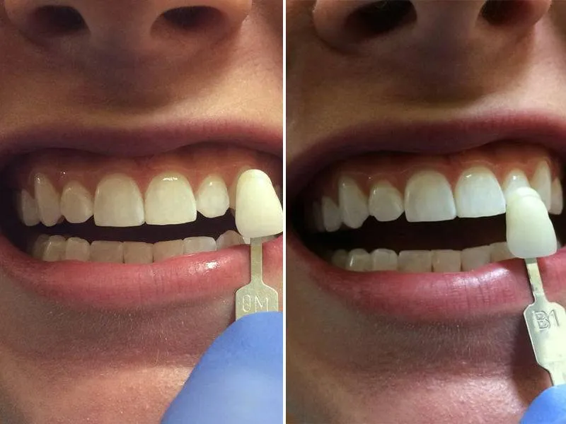 Bright Teeth, Broken Harmony: Why Surface Whitening Alone Cannot Deliver the Smile You Imagined