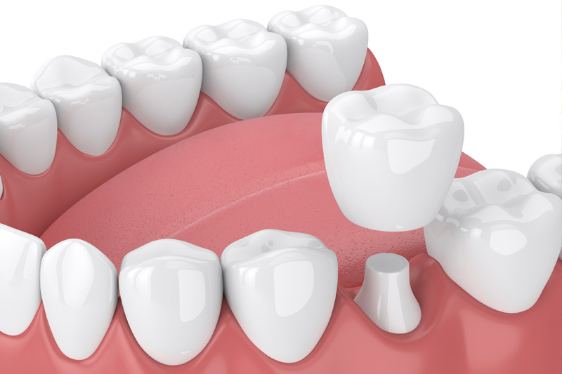 Dental Crowns in San Ramon