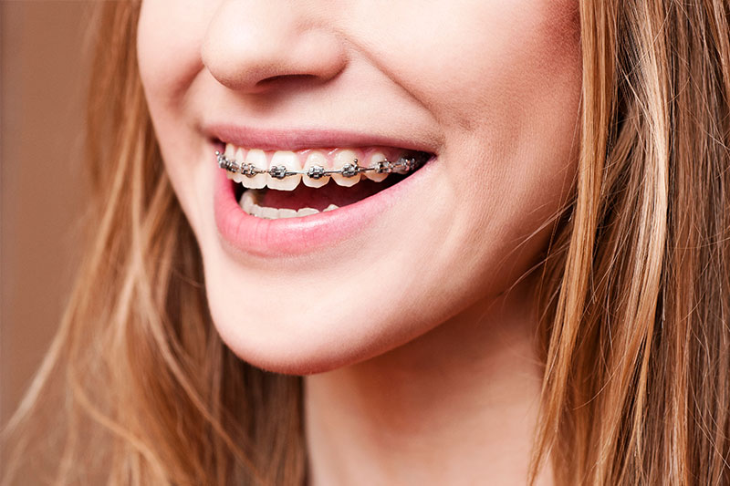 Orthodontics in San Ramon