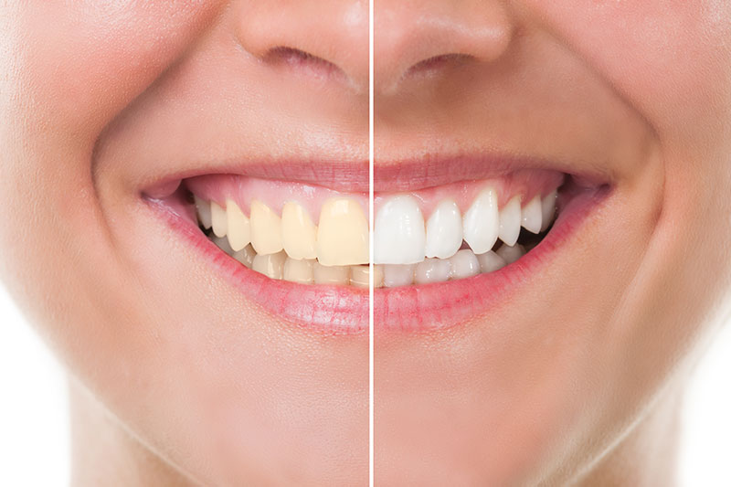 Teeth Whitening in San Ramon