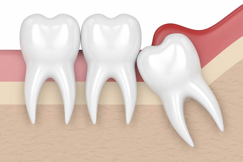 Wisdom Tooth Removal in San Ramon