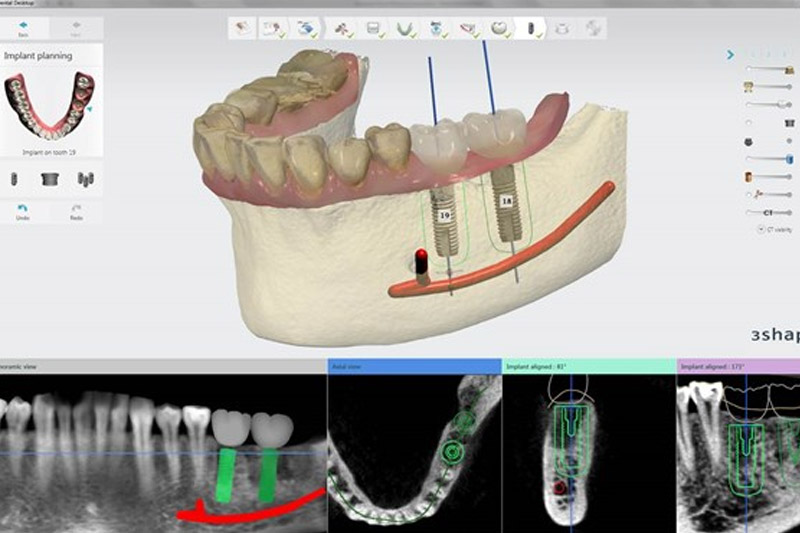 Implant in 