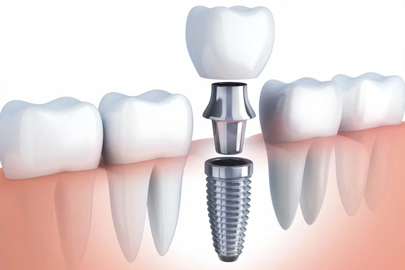 dental implants Services