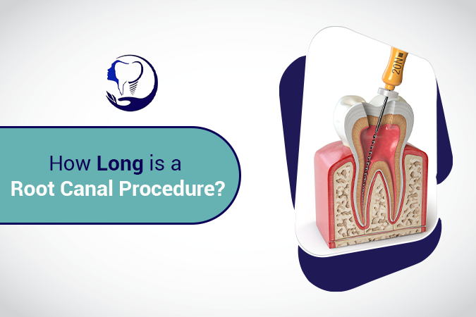 How Long is a Root Canal Procedure?