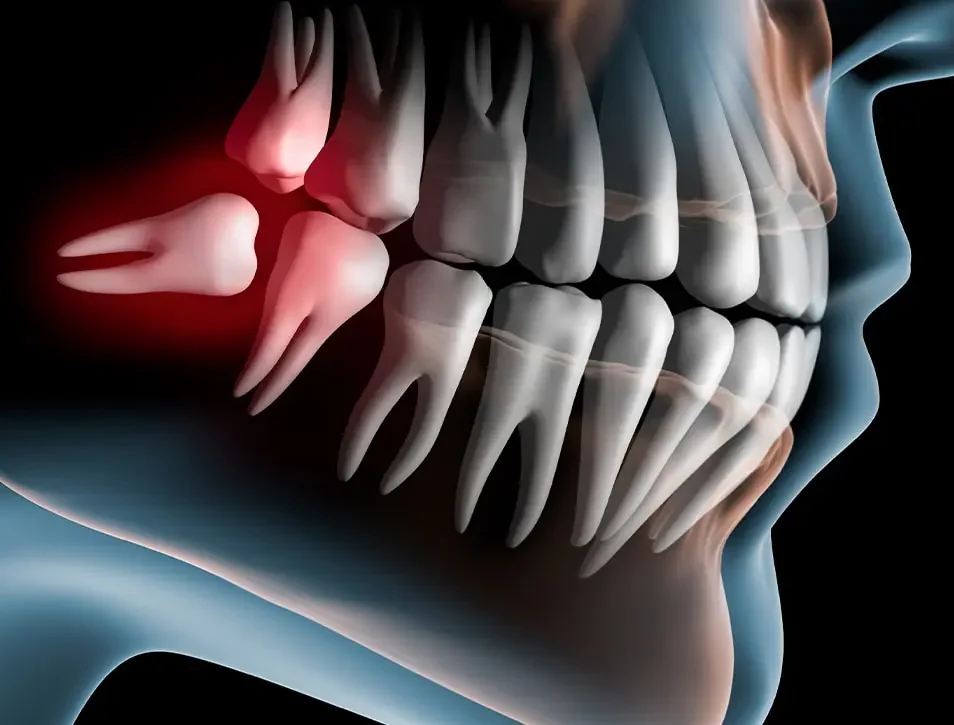 Wisdom Tooth Removal