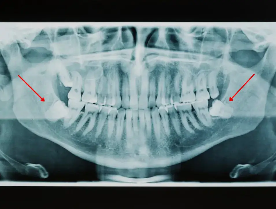 wisdom teeth slider image 2