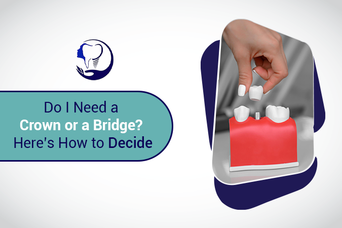 Do I Need a Crown or a Bridge? Here's How to Decide