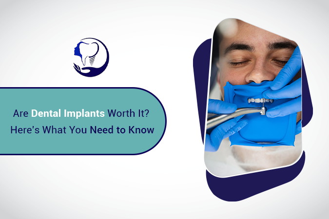 Are Dental Implants Worth It? Here's What You Need to Know