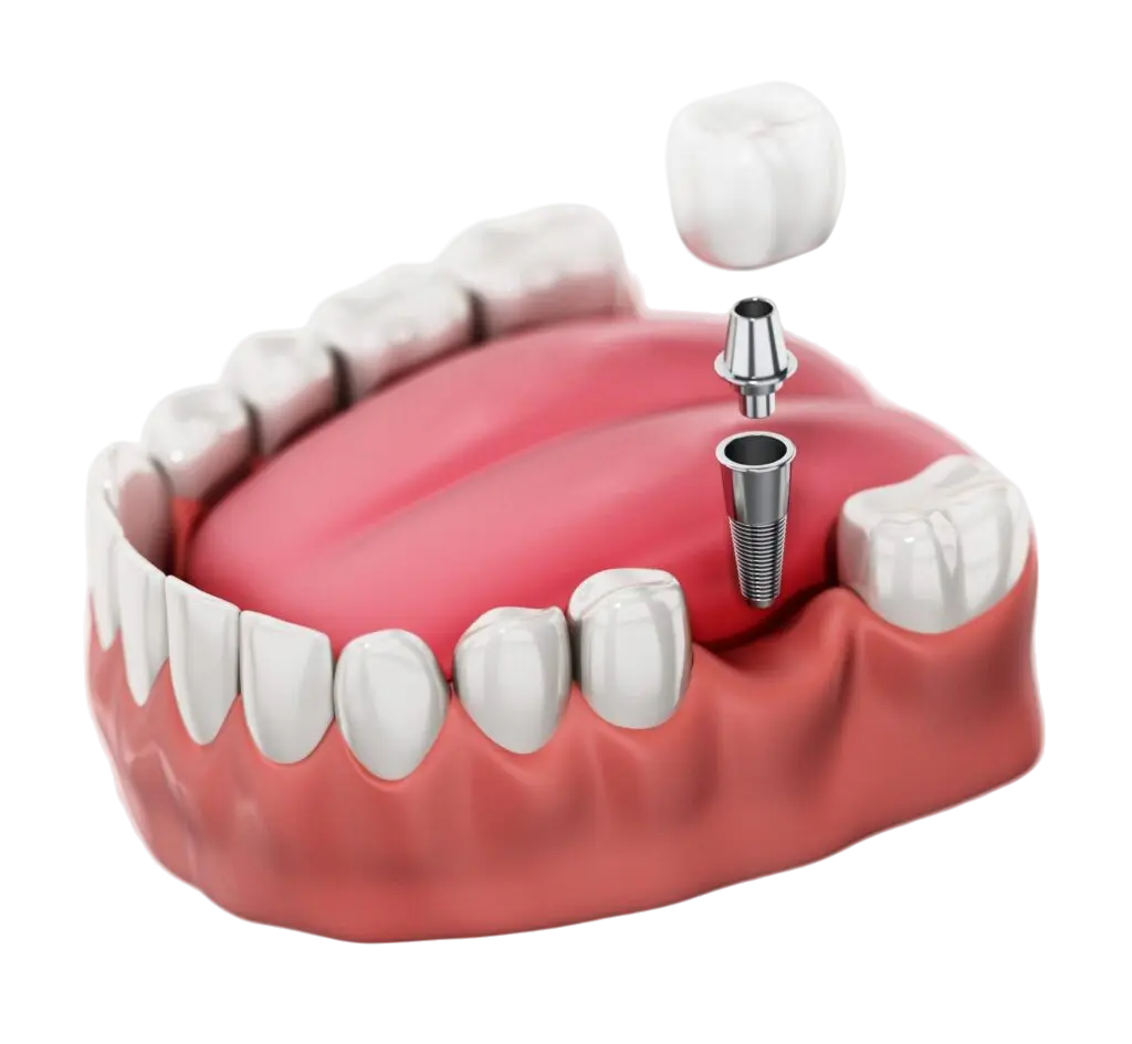 Dental Implant Costs
