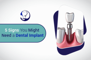 5 Signs You Might Need a Dental Implant