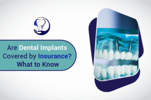 Are Dental Implants Covered by Insurance? What to Know
