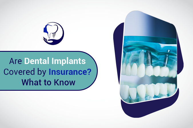 Are Dental Implants Covered by Insurance? What to Know