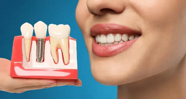 Dental Implant FAQs