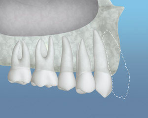bone grafting