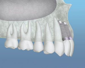 bone grafting
