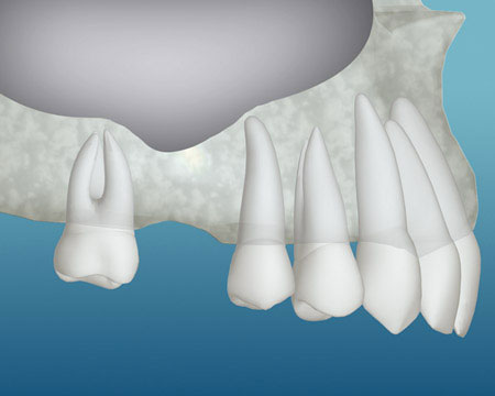 bone grafting