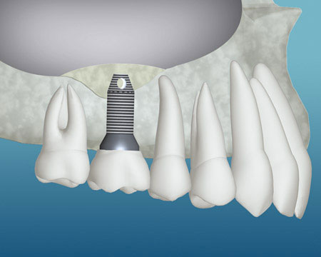 bone grafting