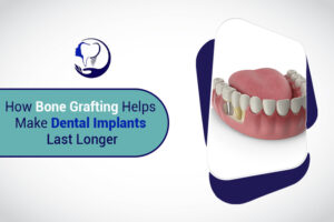 How Bone Grafting Helps Make Dental Implants Last Longer