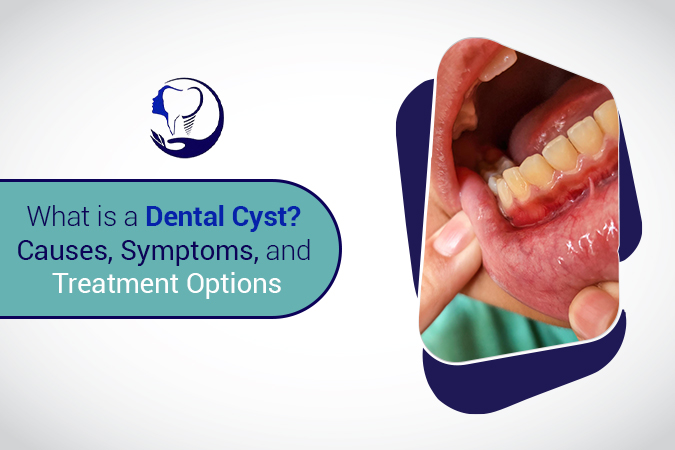 What Is a Dental Cyst? Causes, Symptoms, and Treatment Options