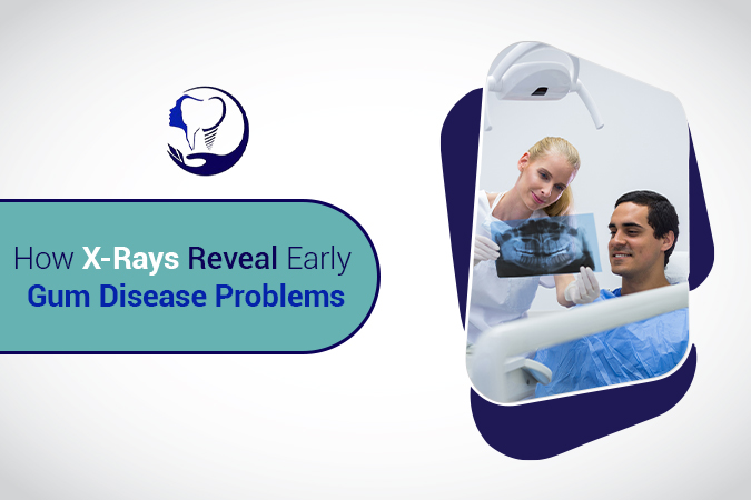 How X-Rays Reveal Early Gum Disease Problems
